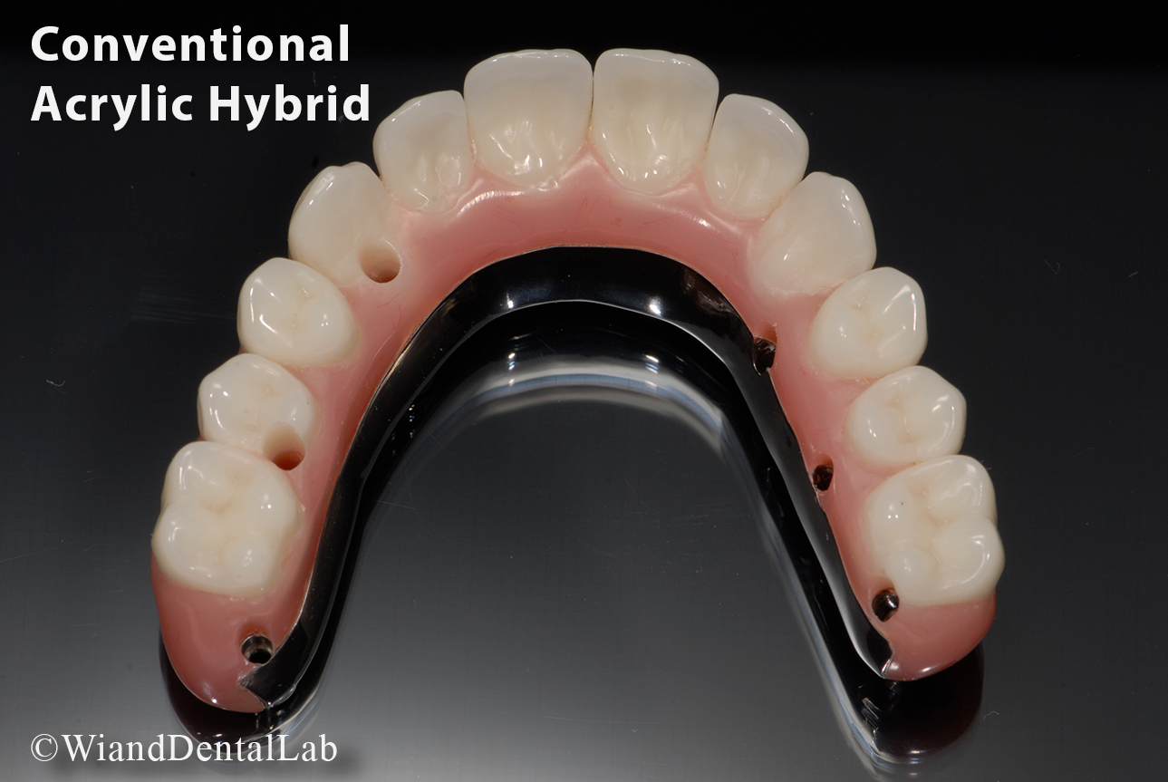 Allon4® Conventional Acrylic Hybrid Wiand Dental Lab