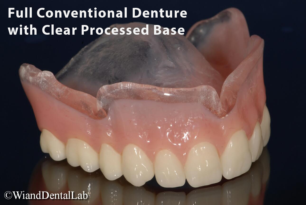 Full Conventional Denture with Clear Processed Base Wiand Dental Lab