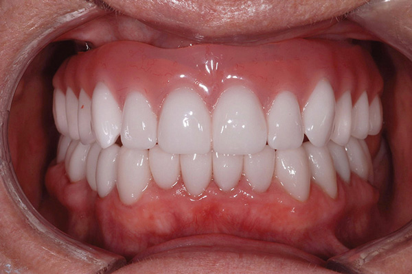 All-on-4® Completed in Mouth