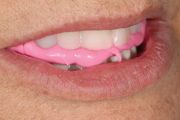 All-on-4® final impression