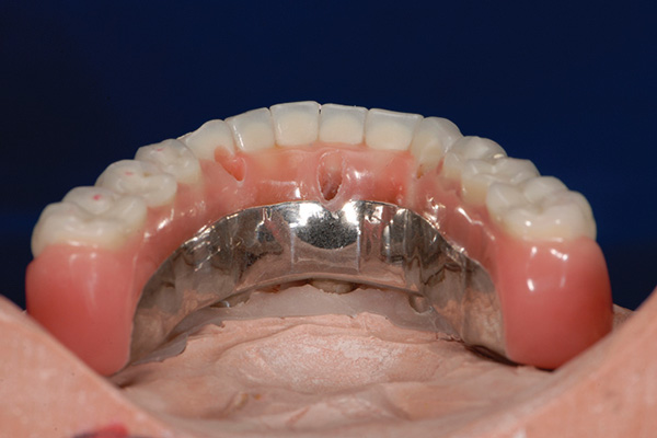 All-on-4® final bar tryln