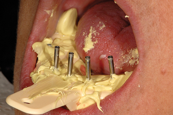 All-on-4® inject
