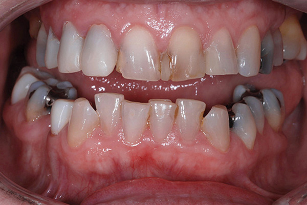 All-on-4® provisional before