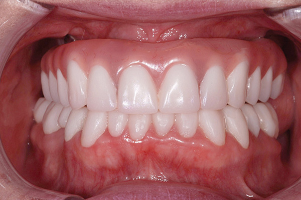 All-on-4® provisional check occlusion
