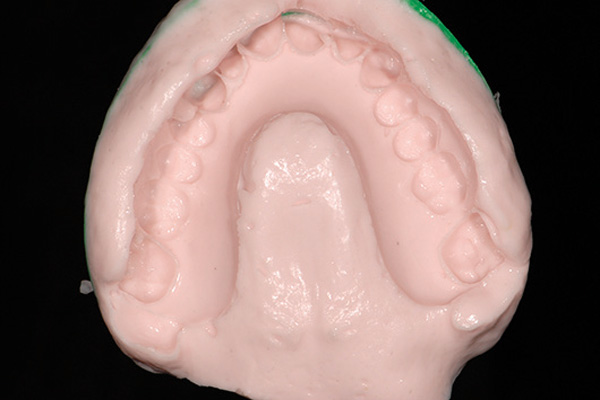 All-on-4® provisional impressions