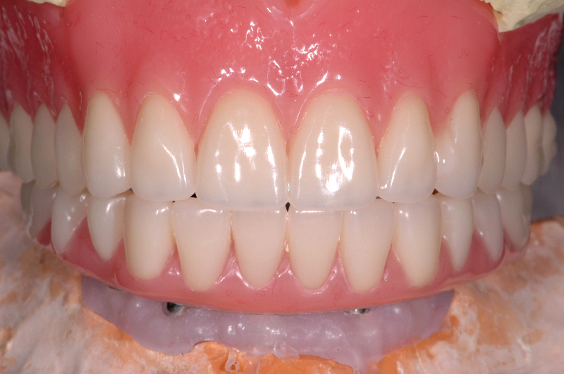 Hybrid bar top and bottom teeth