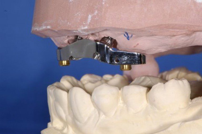 Implant Supported Denture Case Study Wiand Dental Lab