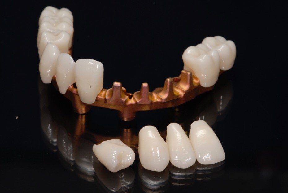 Titanium bar with Zirconia teeth removed
