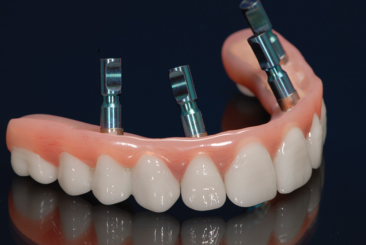 All-on-4® hybrid with a titanium frame and zirconia teeth