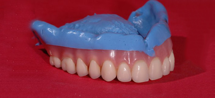 Denture Retention