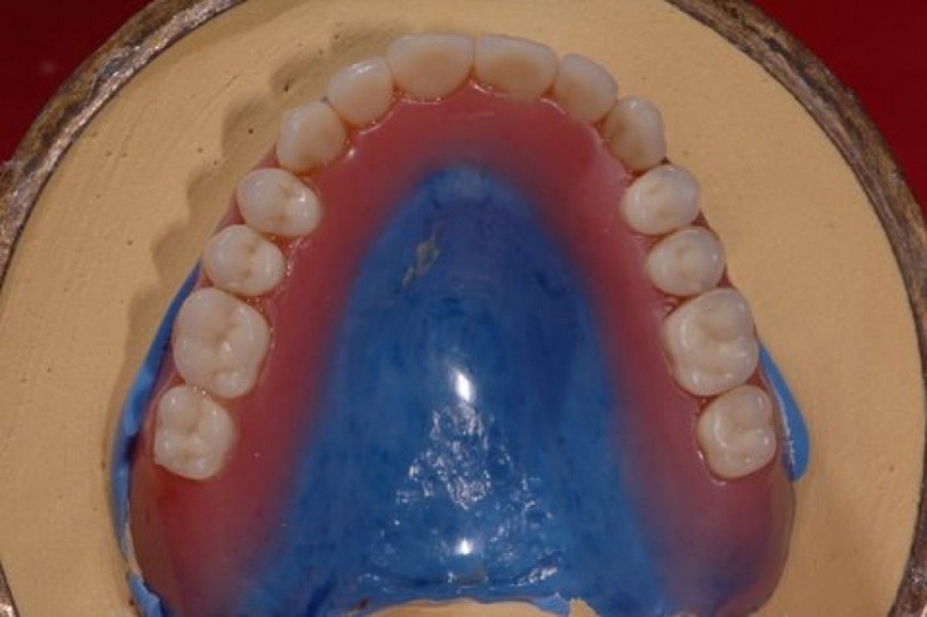 Precise Heat Cured Relines Wiand Dental Lab