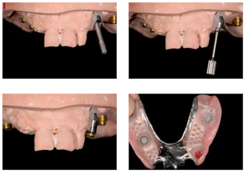 Poorly Aligned Dental Implants
