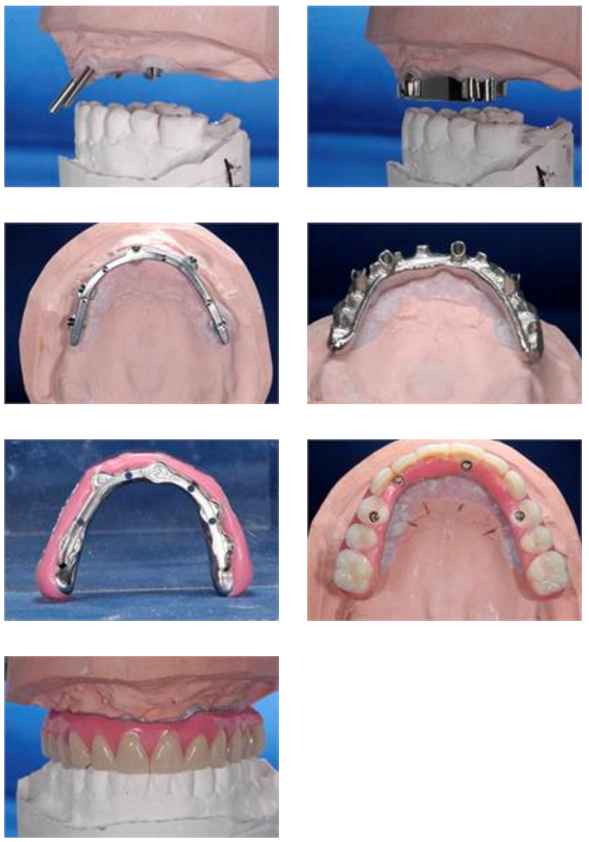 screw-retained prosthesis