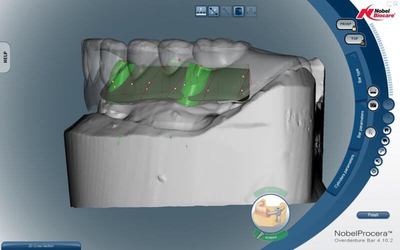 CAD/CAM Implant Bar Design | Titanium Dental Implant Bars | Wiand ...