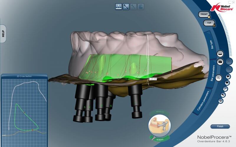 CAD/CAM Implant Bar Design | Titanium Dental Implant Bars | Wiand ...