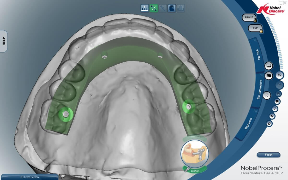 CAD/CAM Implant Bar Design | Titanium Dental Implant Bars | Wiand ...