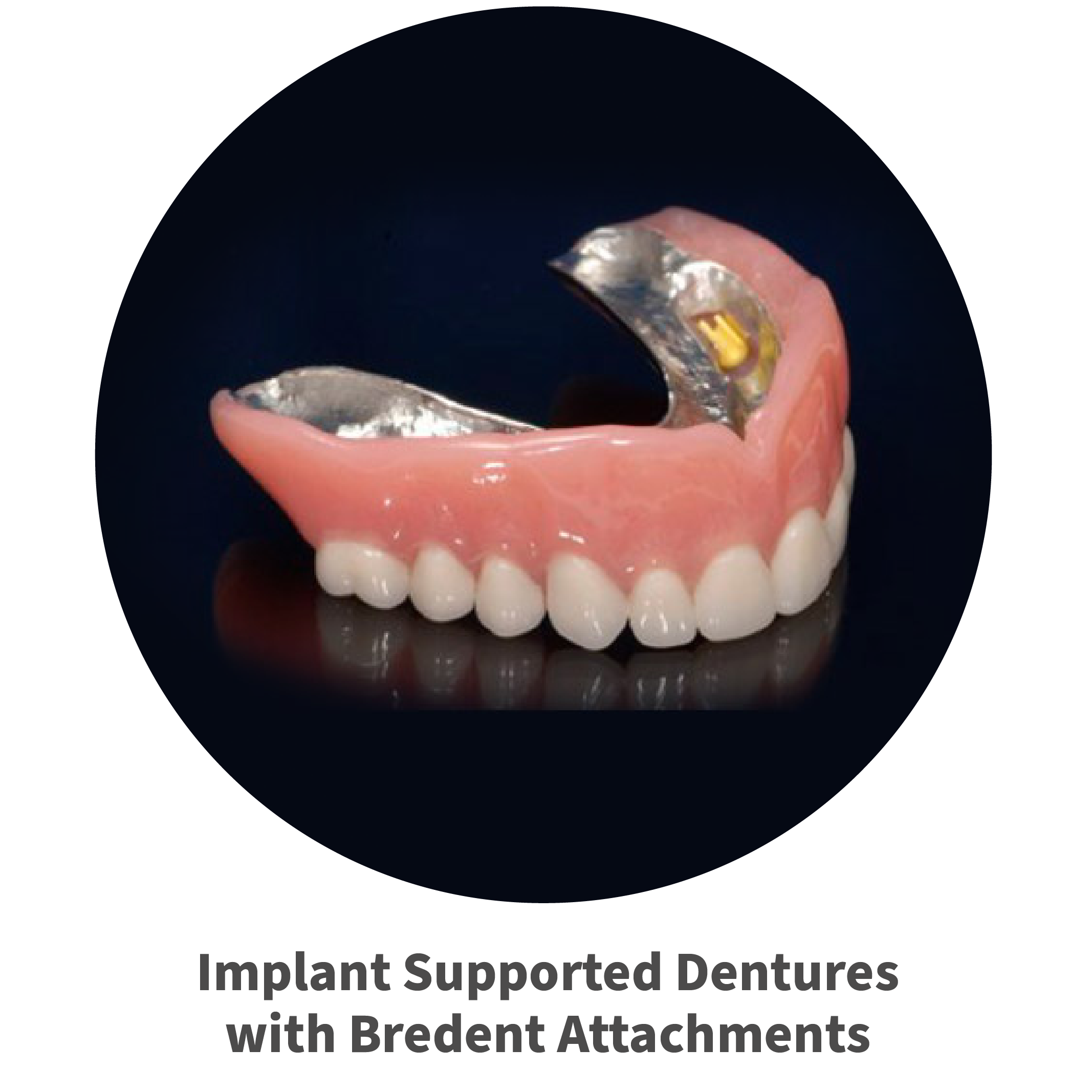 implant supported denture with bredent attachments