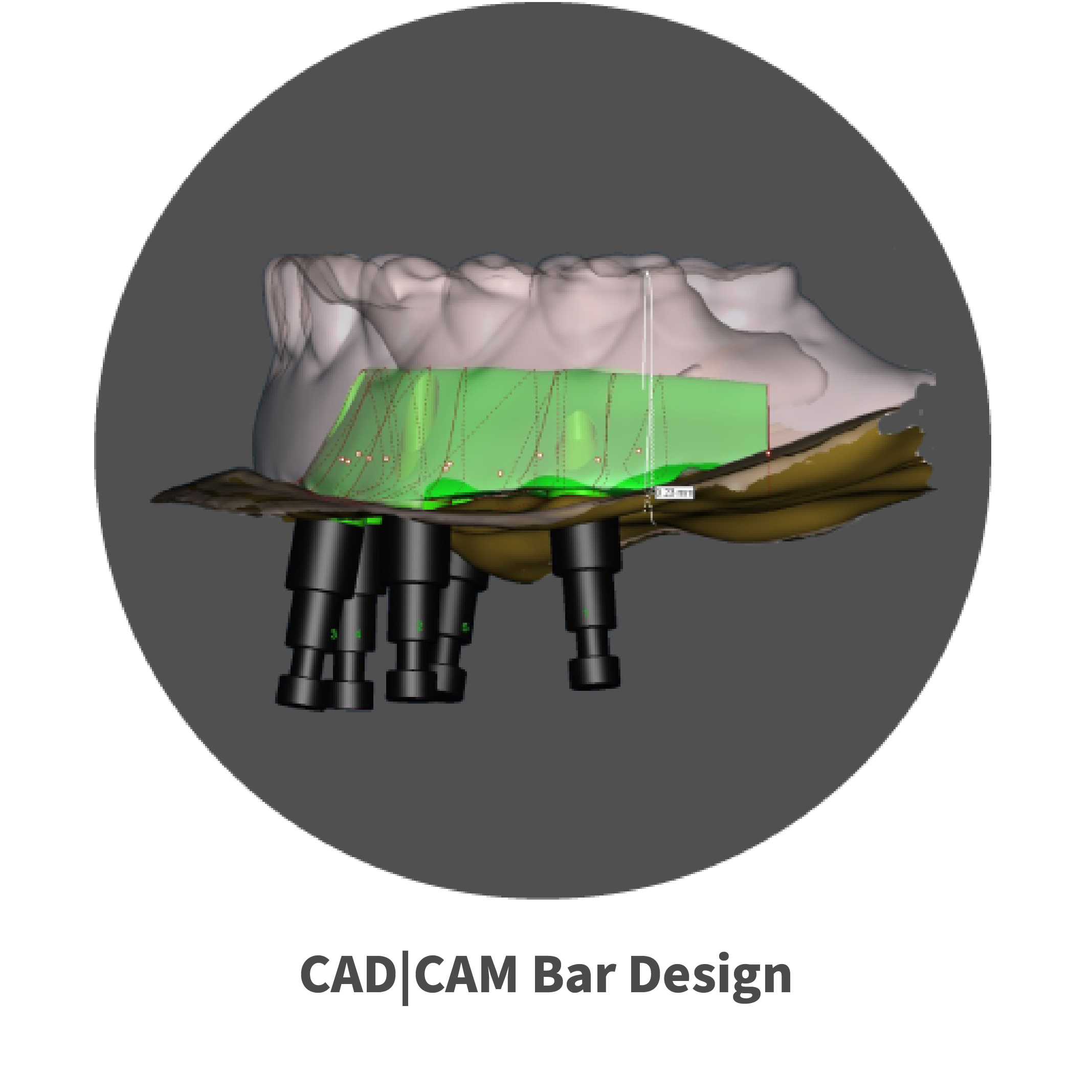 CAD | CAM bar design dental removables