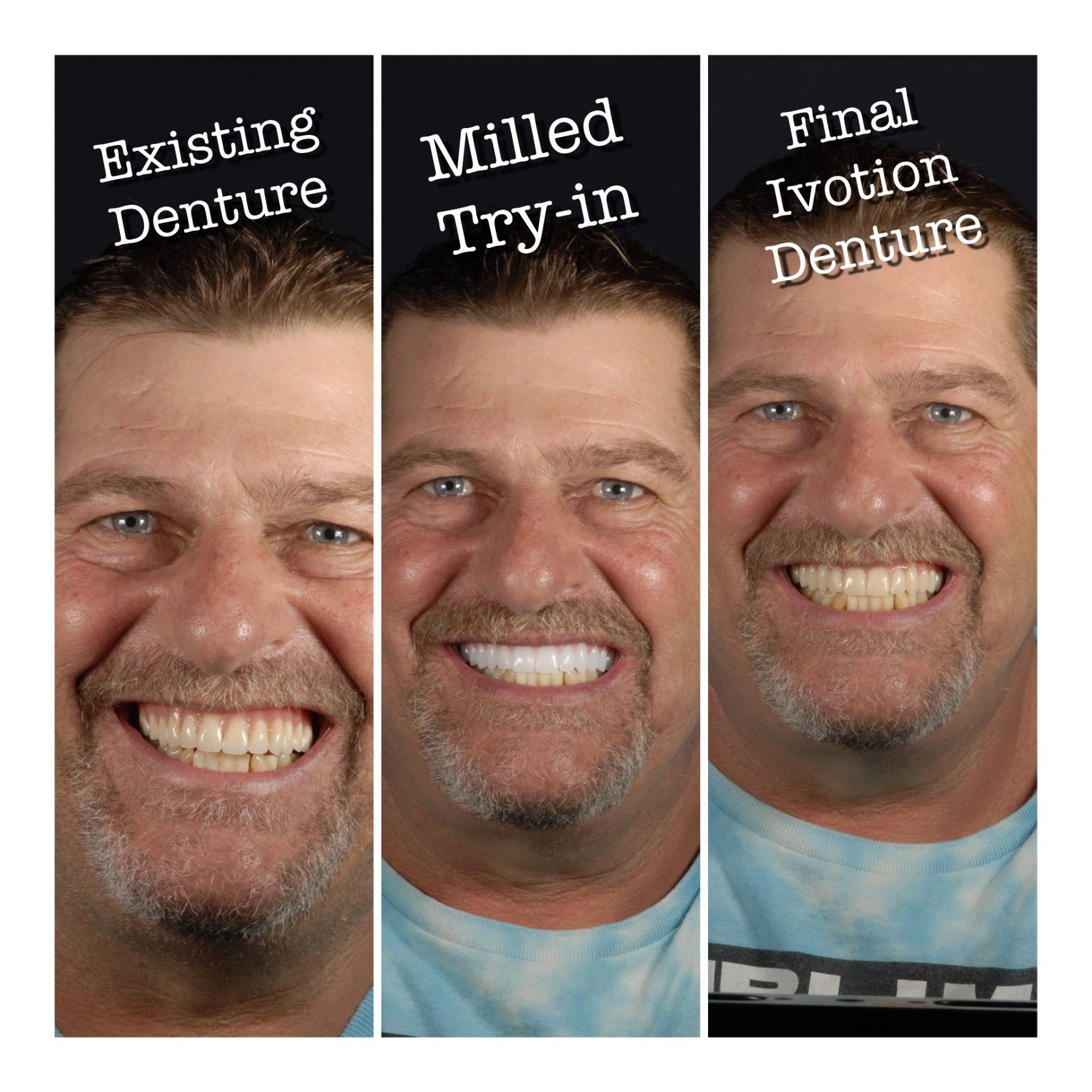 Image in 3 oblong sections, man smiling in all three first "existing denture", second, "Milled Try-in", Third "Final Ivotion Denture"