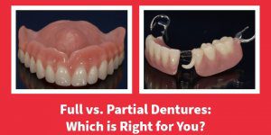 Full vs. Partial Dentures: Which is Right for Your Patients?