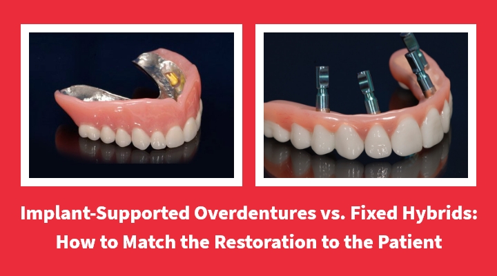 Implant-Supported Overdentures vs. Fixed Hybrids: How to Match the Restoration to the Patient
