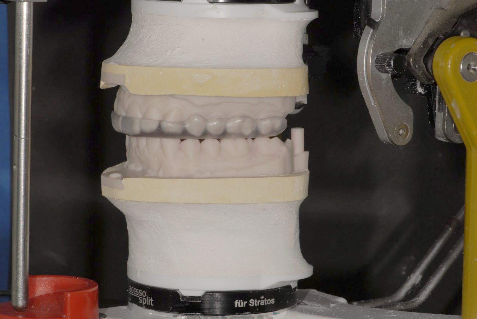 Nightguard mounted on a semi-adjustable articulator (placeholder photo)